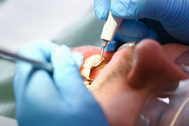 Best Emergency Root Canal Treatment in Vero Lake Estates, FL